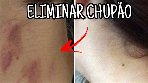 como tirar chupada|Como tirar chupão: 8 truques simples para remover。